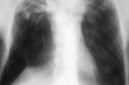 Ilustrasi hasil rontgen dada pasien tuberkulosis. (Foto: Wikimedia Commons, CC BY 4.0)