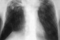 Ilustrasi hasil rontgen dada pasien tuberkulosis. (Foto: Wikimedia Commons, CC BY 4.0)