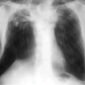 Ilustrasi hasil rontgen dada pasien tuberkulosis. (Foto: Wikimedia Commons, CC BY 4.0)