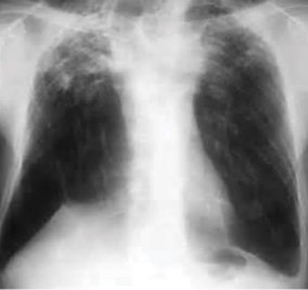 Ilustrasi hasil rontgen dada pasien tuberkulosis. (Foto: Wikimedia Commons, CC BY 4.0)